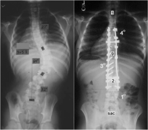 Posterior spinal fusion using the Legacy System