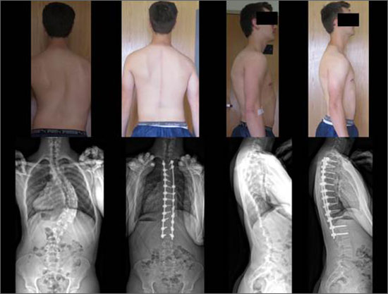 Bryce S Scoliosis Patient Lawrence G Lenke Md