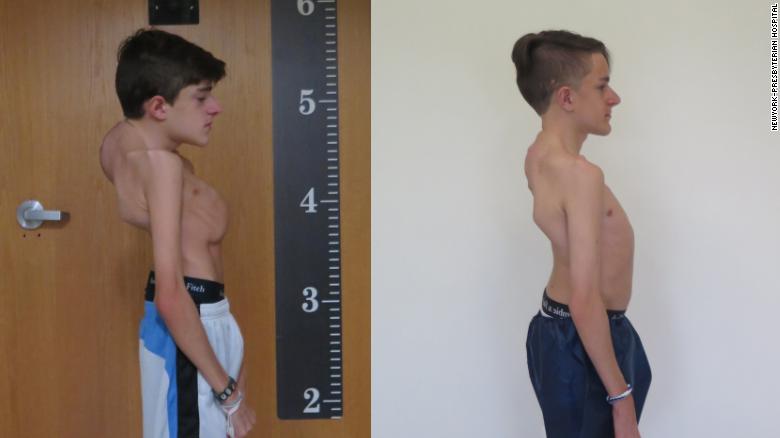 John-S-Before & After Lawrence Lenke Operation Scoliosis Kyphosis Surgery