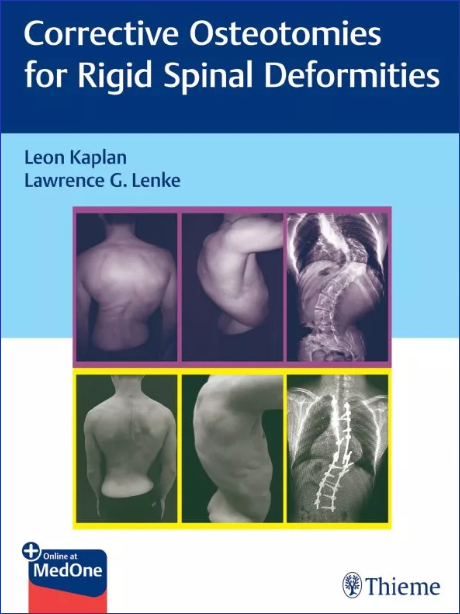 Corrective Osteotomies for Rigid Spinal Deformities Book