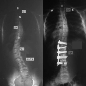 An anterior spinal fusion using the Legacy System