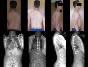Bryce-before and after spine surgery by Dr. Lenke-for scoliosis