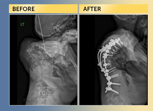 Dr Lenke-Spine Deformity Case-Miqad