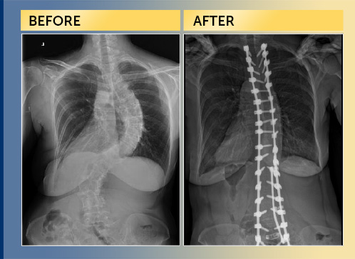 Dr. Lenke-Spine-Scoliosis Case